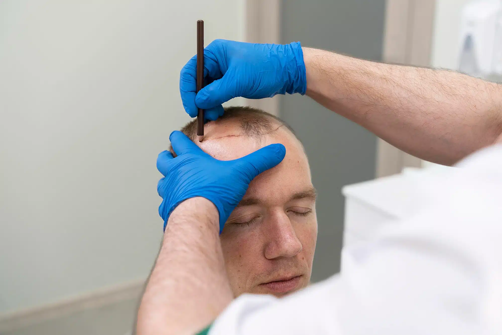 زراعة الشعر في تركيا - إسطنبول Esteniv